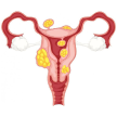 fibrome uterin