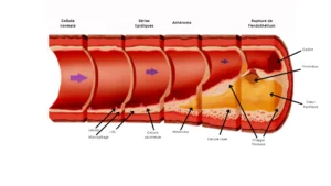 Blog 5 Athérosclérose