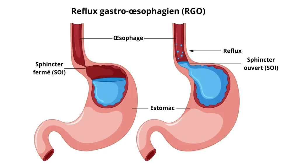 Reflux gastro-œsophagien