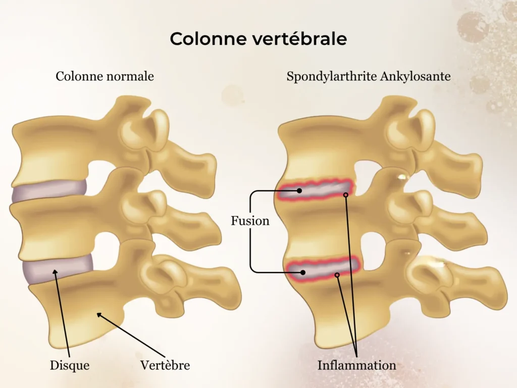 Spondylarthrite ankylosante